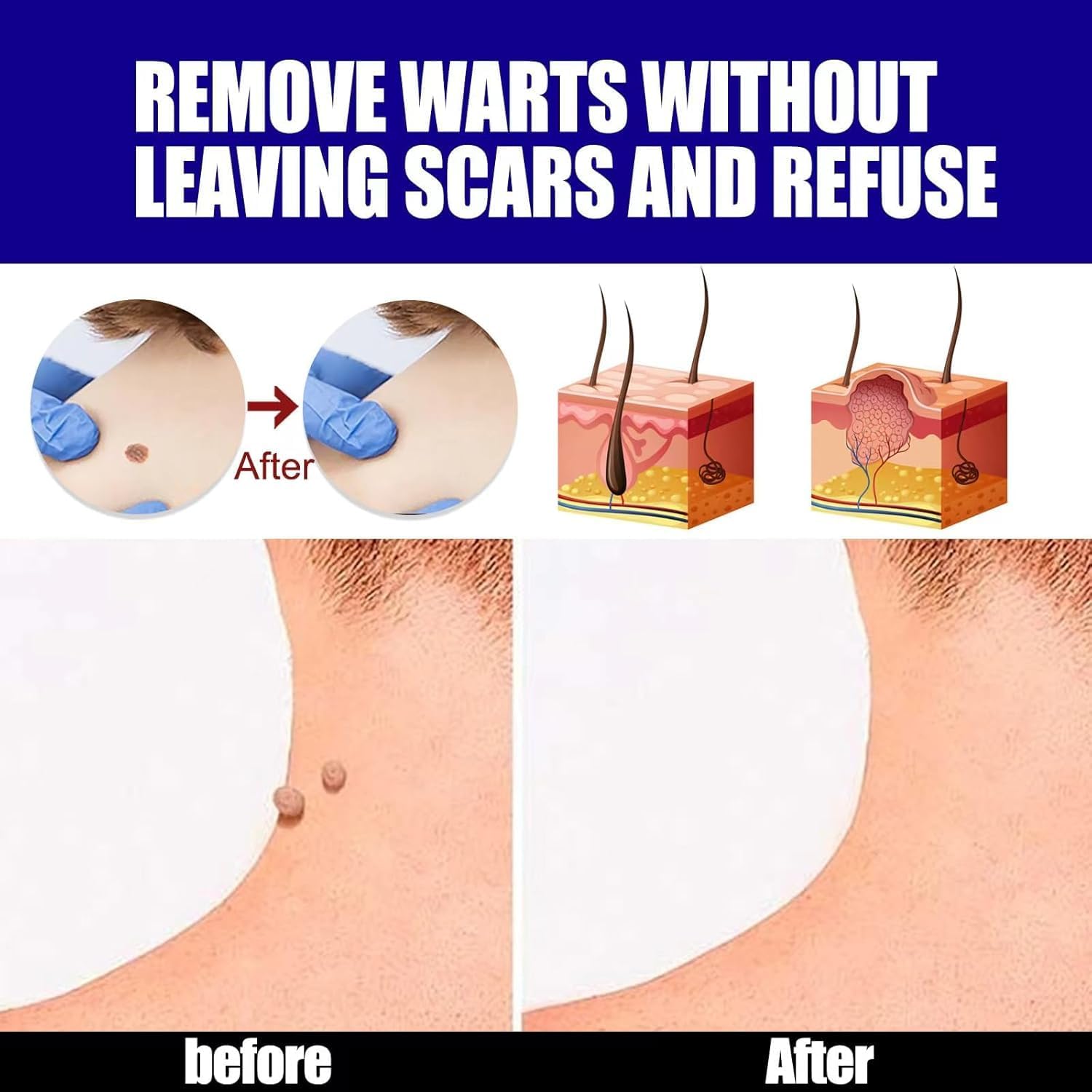 Warts Remover Ointment – Fast, Gentle &amp; Effective Treatment for Warts - Desertcart.store
